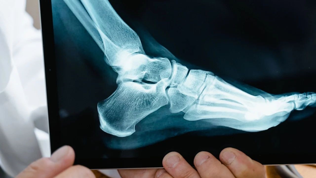Un cliente sufrió una fractura luego de que una caja de pisos le cayera sobre un pie dentro de un local Easy. La Cámara neuquina sostuvo que la empresa no logró probar que el accidente hubiera sido provocado por una conducta imprudente del consumidor.